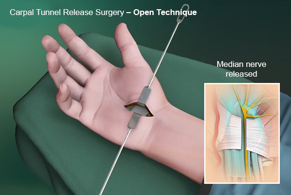 Carpal Tunnel Release Surgery